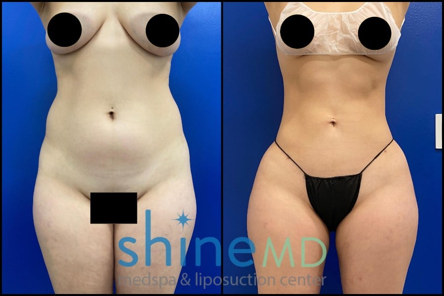 Lipo 360 with BBL before and after front view patient 1533385