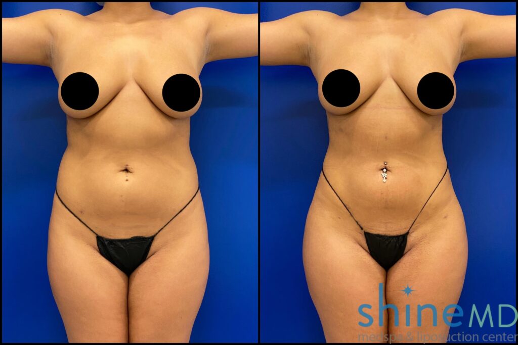lipo 360 with BBL before and after