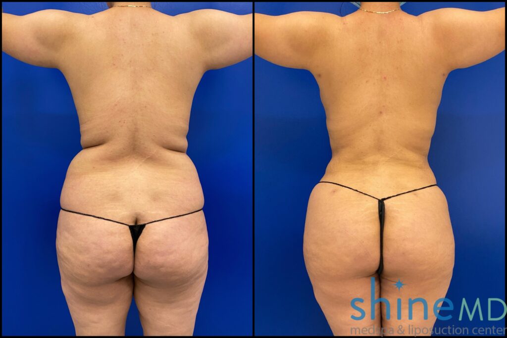 Snatched waist after liposuction 360