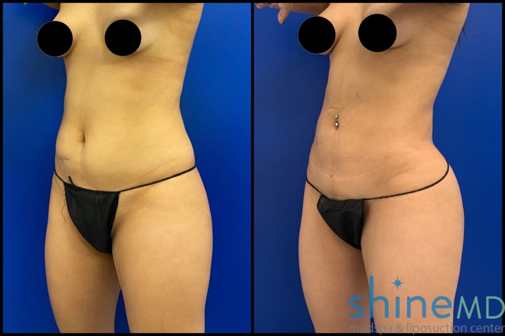 Liposuction 360 before and after