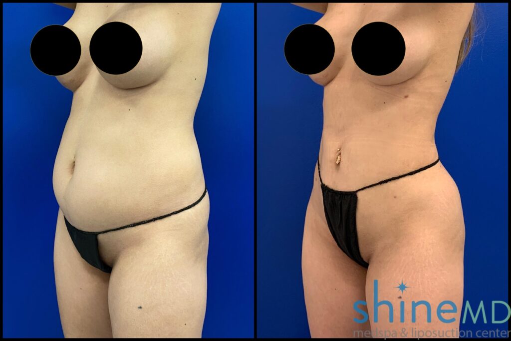 360 lipo before and after picture