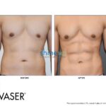 vaser liposuction with abs etching male 1