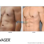 vaser liposuction with abs etching in male 2