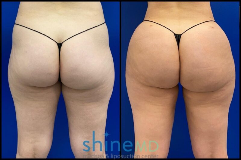 fat transfer to buttocks amazing bbl results patient 002041 shinemd