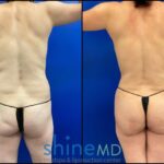Left Back Oblique liposuction and bbl before and after results patient shinemd 002048