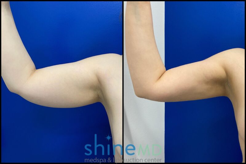 Front Right Arm results liposuction patient shinemd 002047