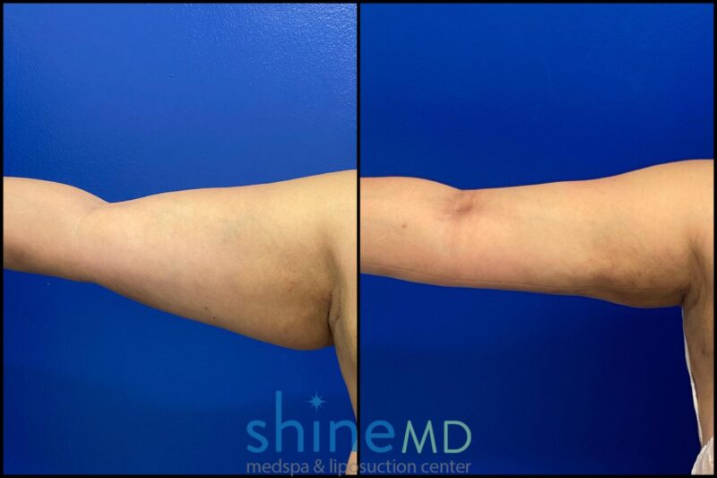 Front view of Right arm lipo results before and after patient shine 002050
