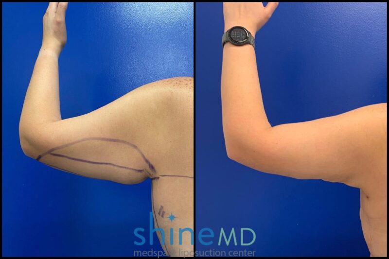 Left Back Arm Liposuction results patient shinemd 002040
