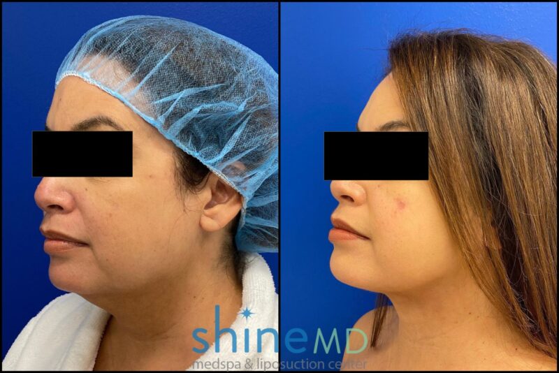 Left side view of Right Chin liposuction at three month post op