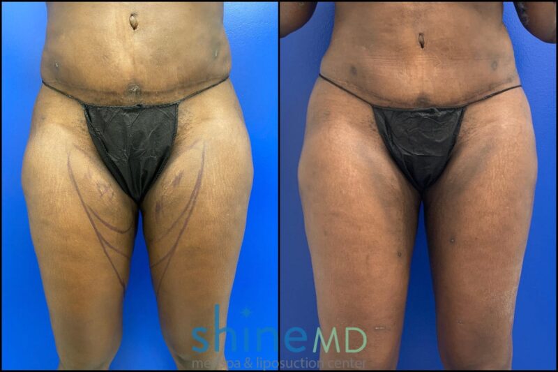 Inner Thigh Front lipo results shine md before and after gallery amazing results for patient 002039