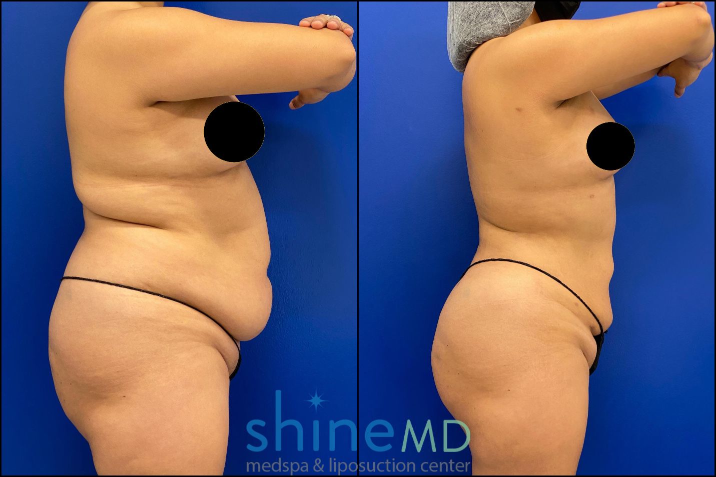 Ozempic vs. VASER Liposuction: Here's How to Choose - 360 Plastic Surgery