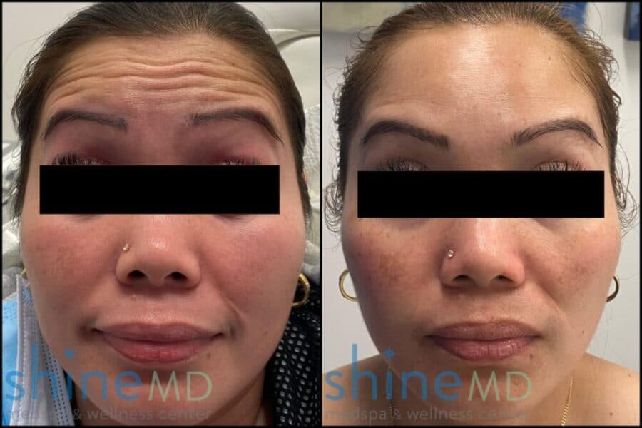 Botox before and after in forehead wrinkles