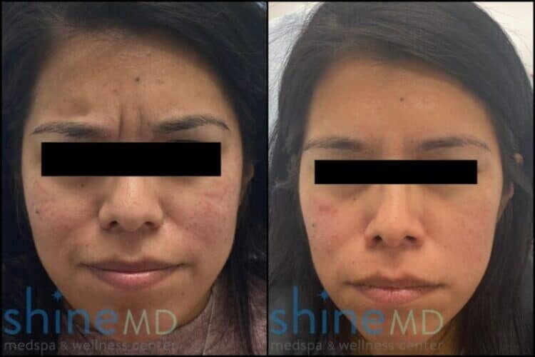 botox glabella before and after PATIENT 002069