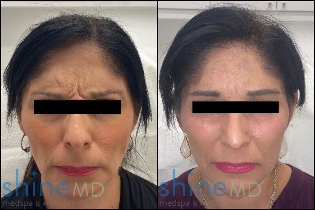 Front view Botox for Glabella PATIENT 002059