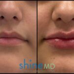 Front Lip view for Juvederm Ultra XC patient 002054