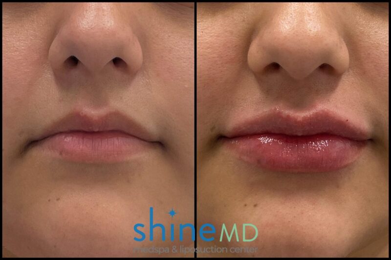 Front Lip view for Juvederm Ultra XC patient 002054