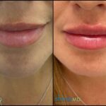 Front view Juvederm XC on Lips