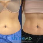 Front View CoolSculpting Result PATIENT-ShineMD-002081