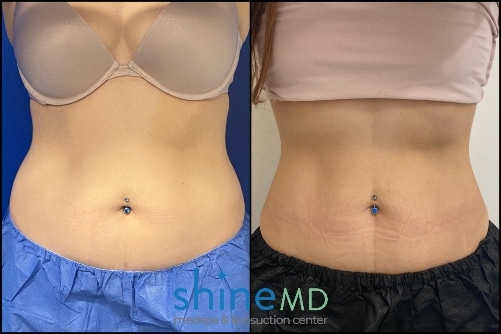 Front View CoolSculpting Result PATIENT-ShineMD-002081