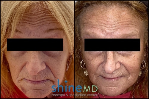 Botox for forehead before and after patient 2080
