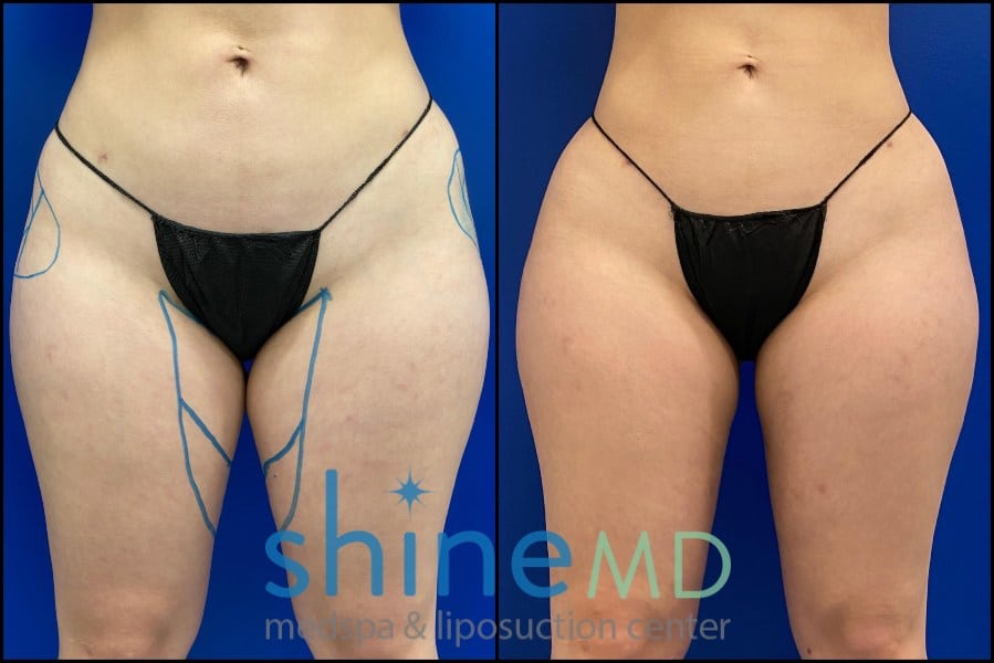 inner thigh lipo before and after results front view 002079