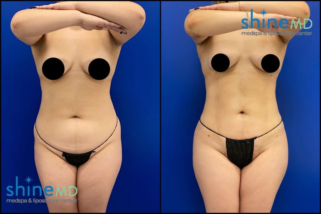 lipo 360 with BBL before and after