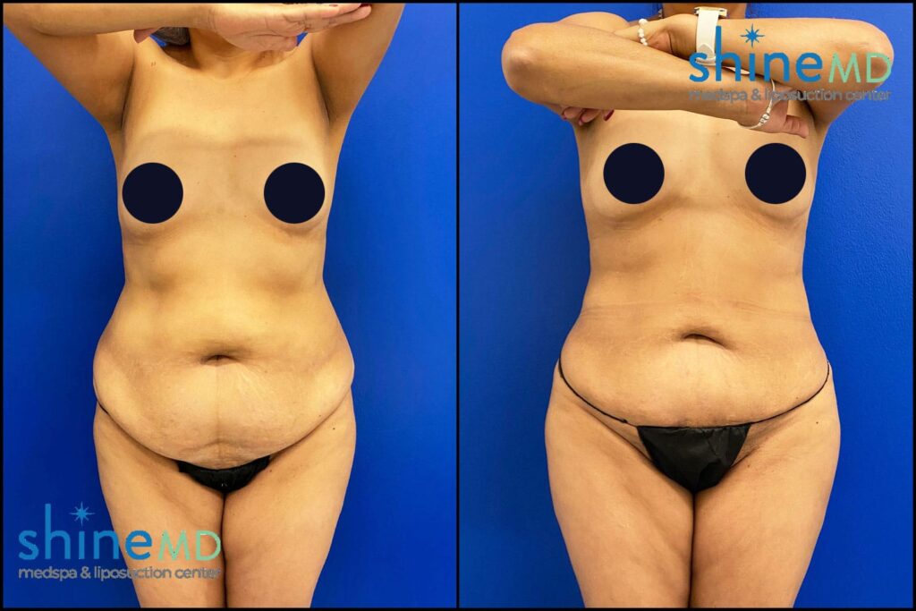 360 lipo Before after