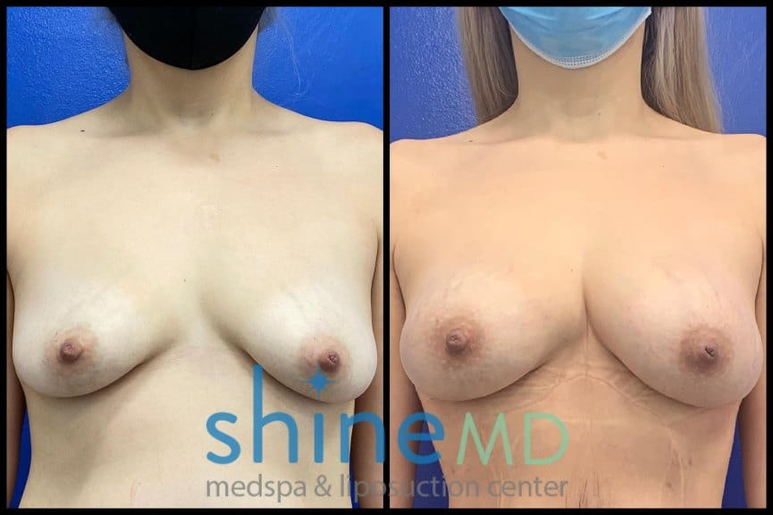 Breast Augmentation Before After patient 1316360