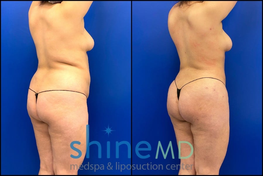 Vaser lipo 360 with BBL before and after results back oblique view patient 2316689