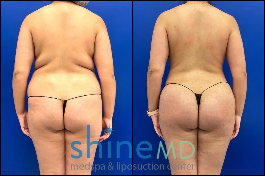 Vaser lipo 360 with BBL before and after results back view patient 2316689