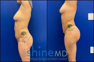 Lipo 360 with BBL before and after photos side view patient 1829231