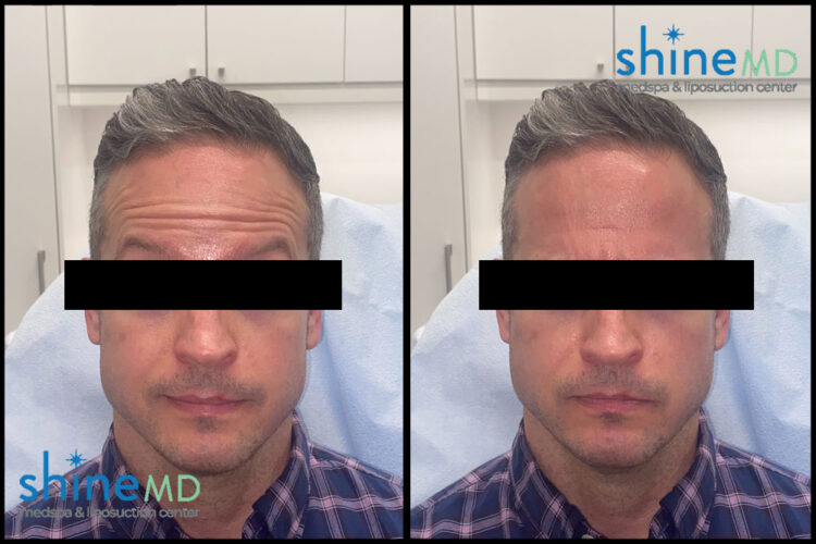Botox on Forehead Before After Result Houston